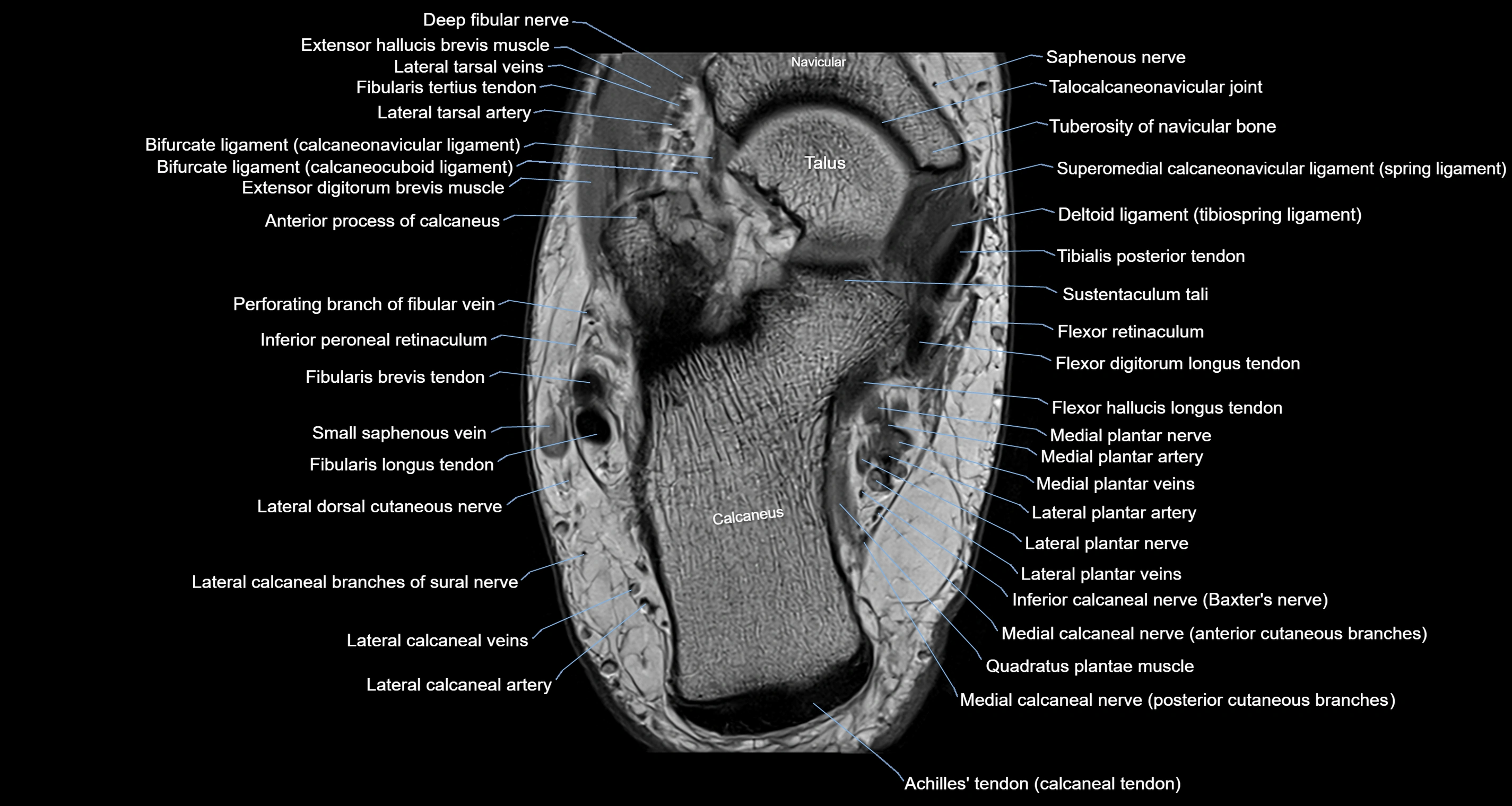 Ankle axial anatomy 3T MRI images -img-10001-00026.webp